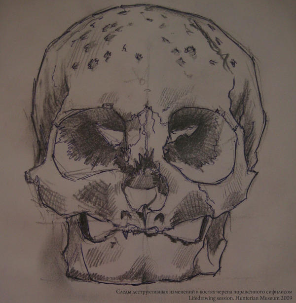 Sifilitic_Skull_by_vianreps.jpg