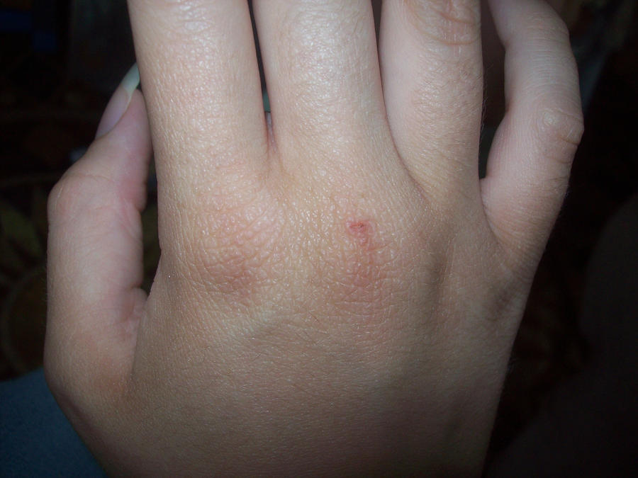 mild eczema on hand